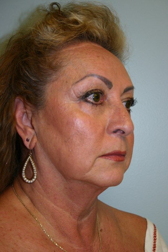 Face Lift Before & After