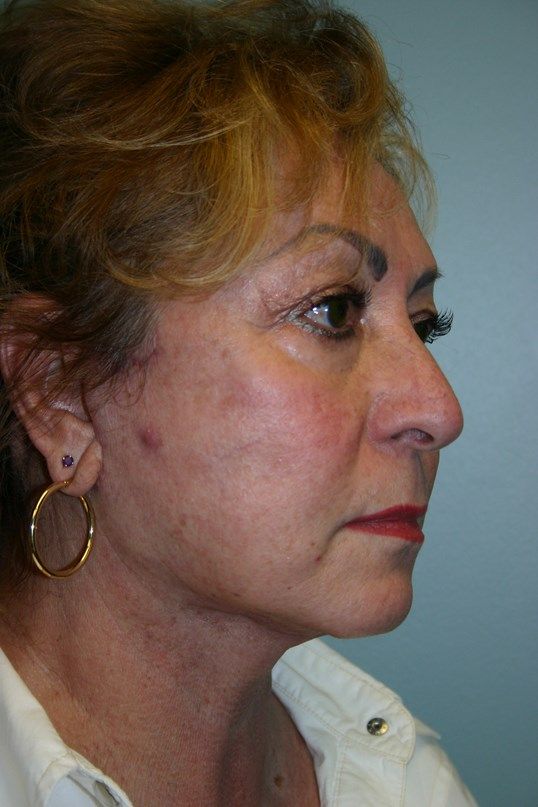Face Lift Before & After
