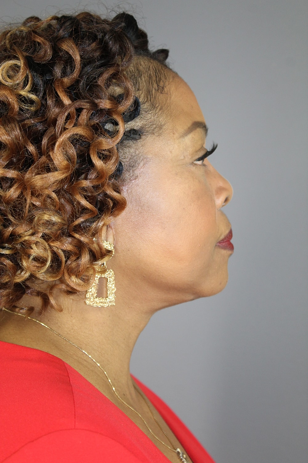 Face Lift Before & After