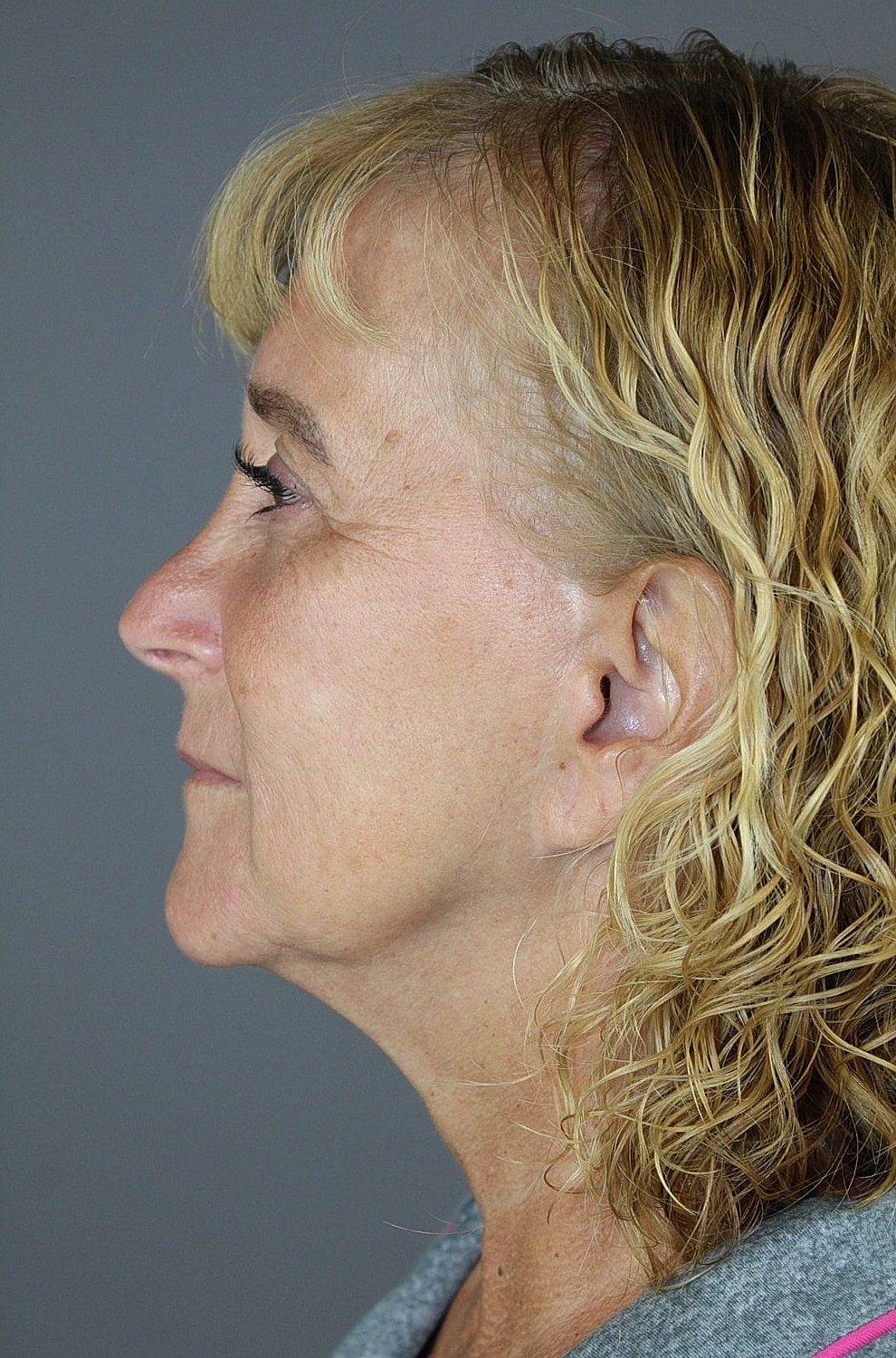 Face Lift Before & After