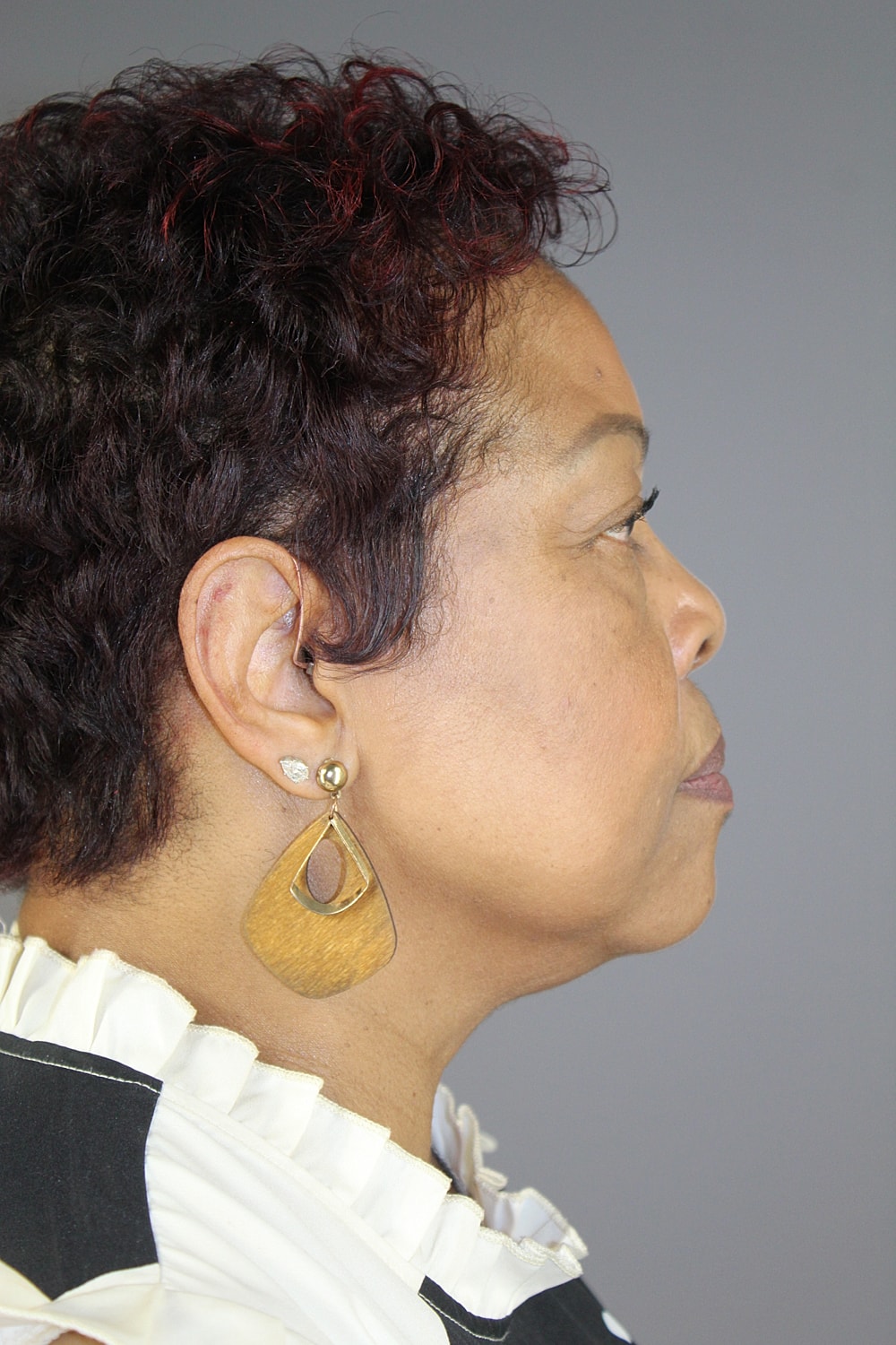 Face Lift Before & After