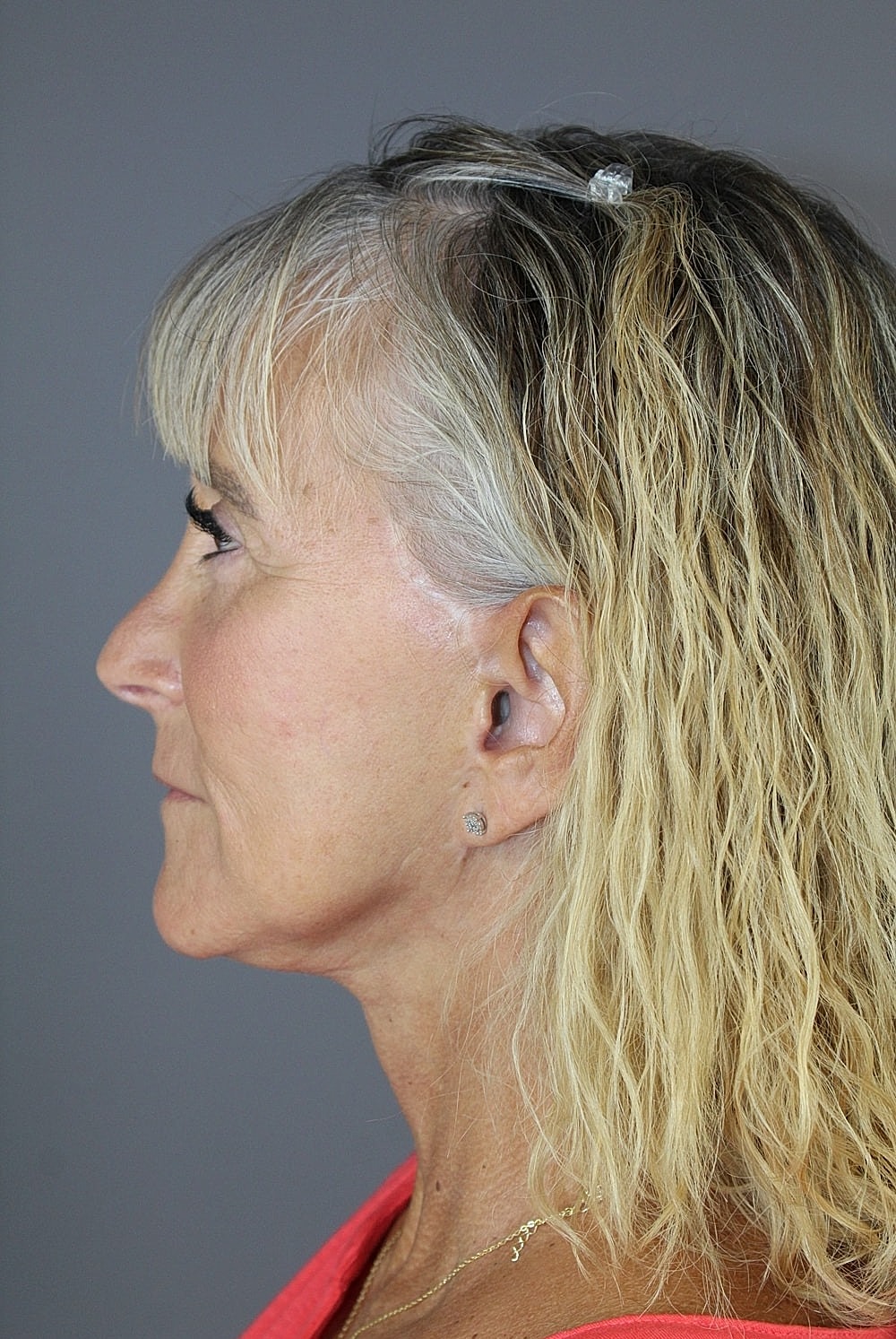 Face Lift Before & After