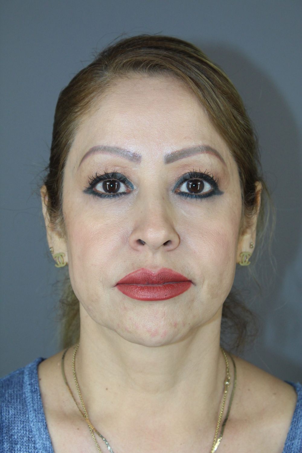 Neck Lift Before & After