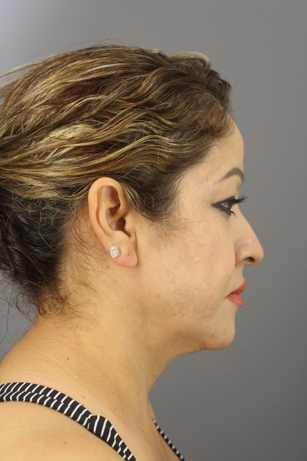 Neck Lift Before & After