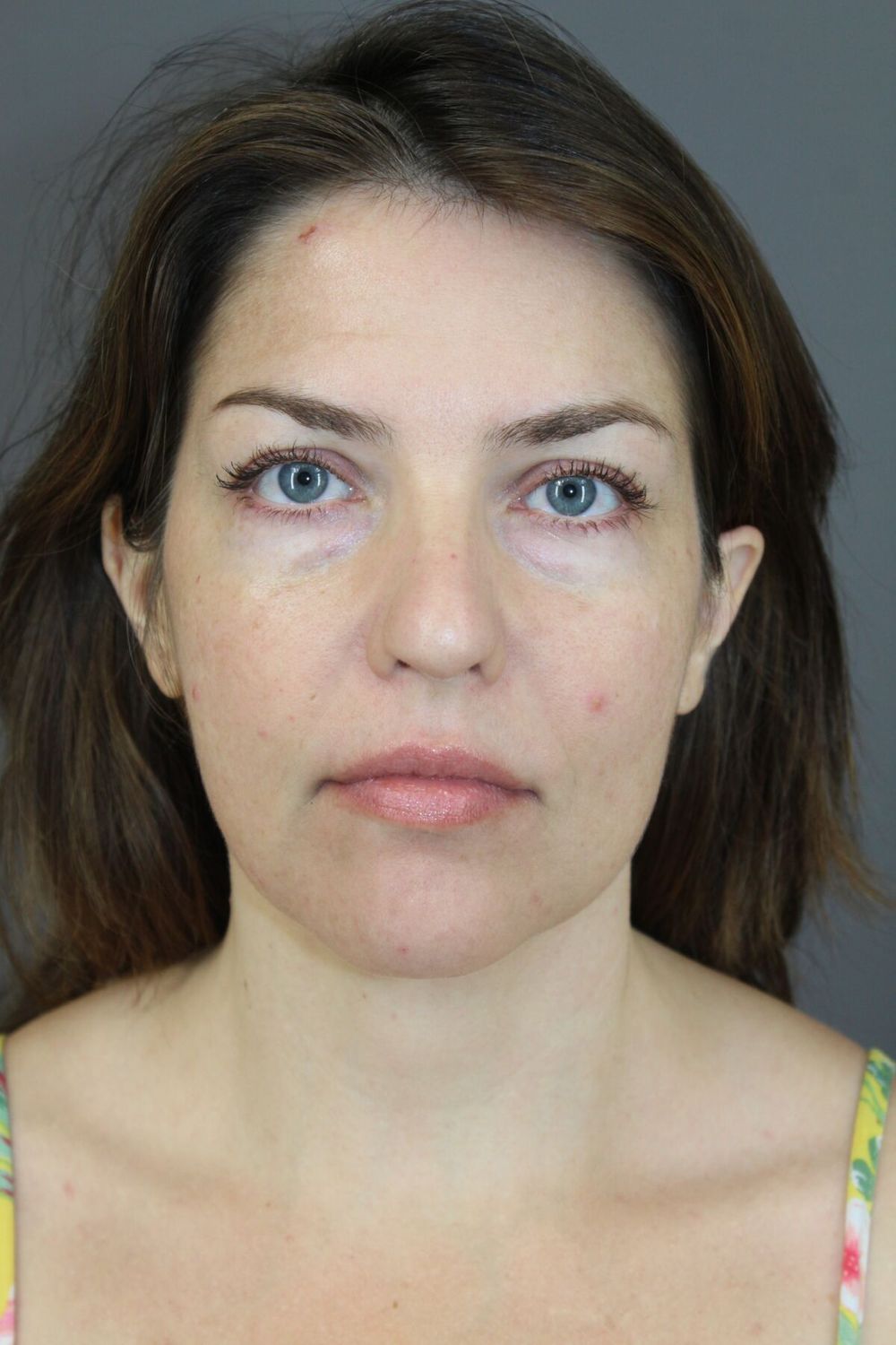 Neck Lift Before & After