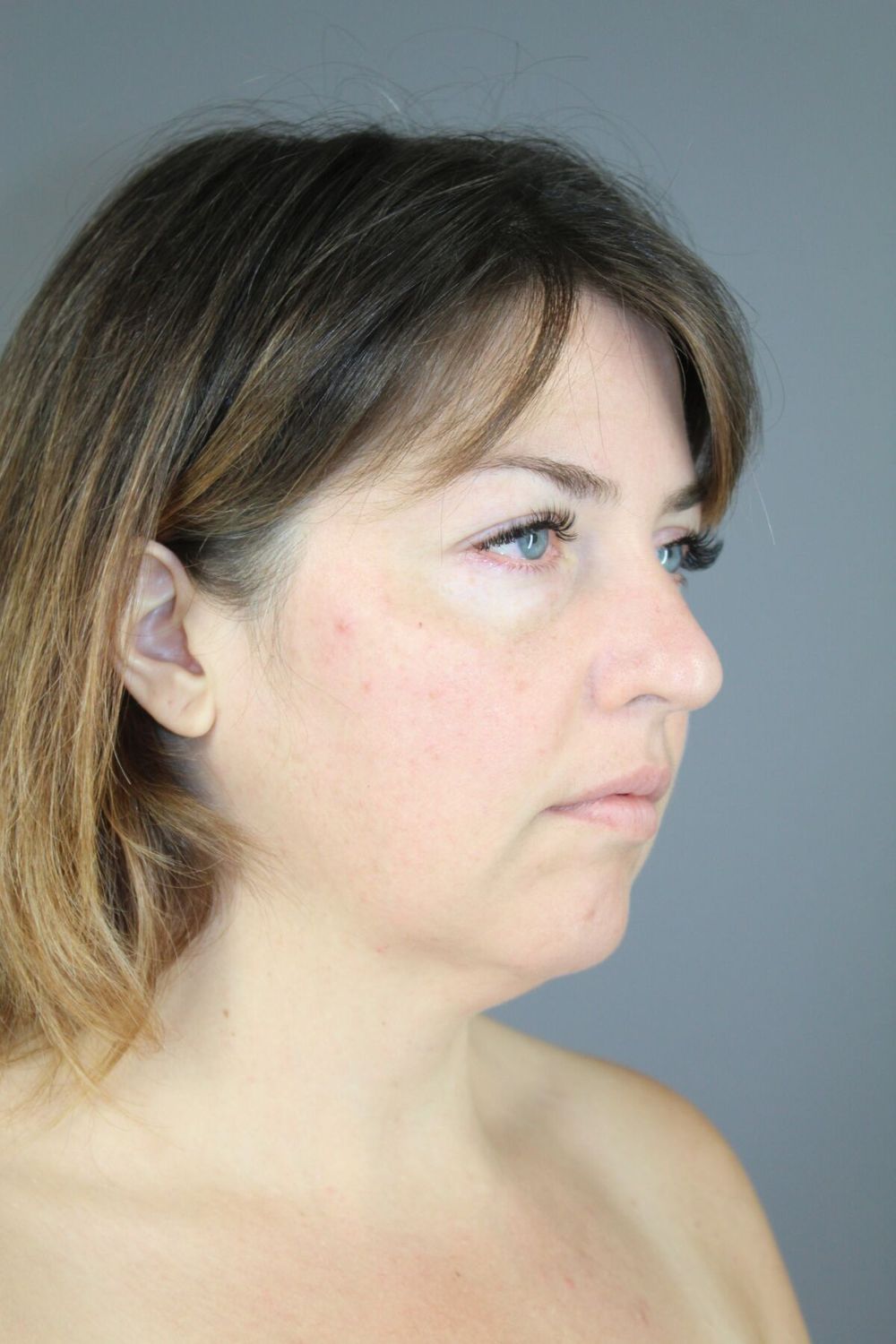 Neck Lift Before & After