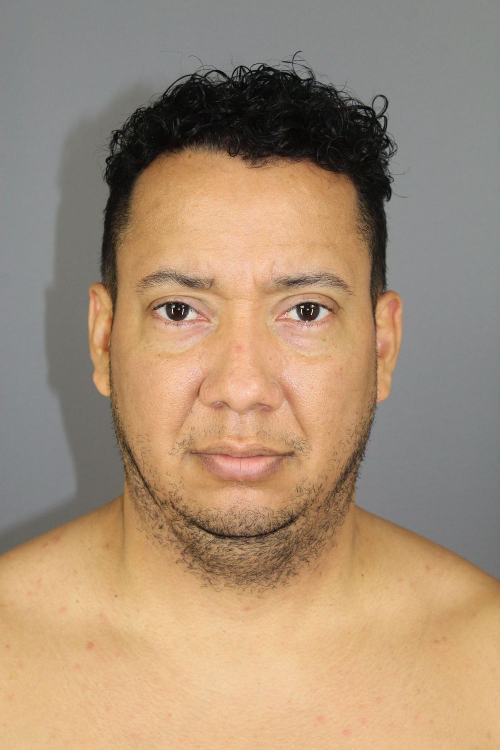 Neck Lift Before & After