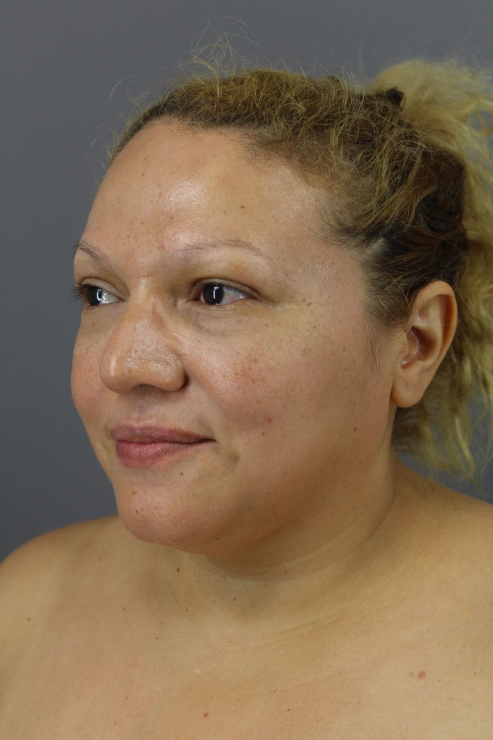 Neck Lift Before & After