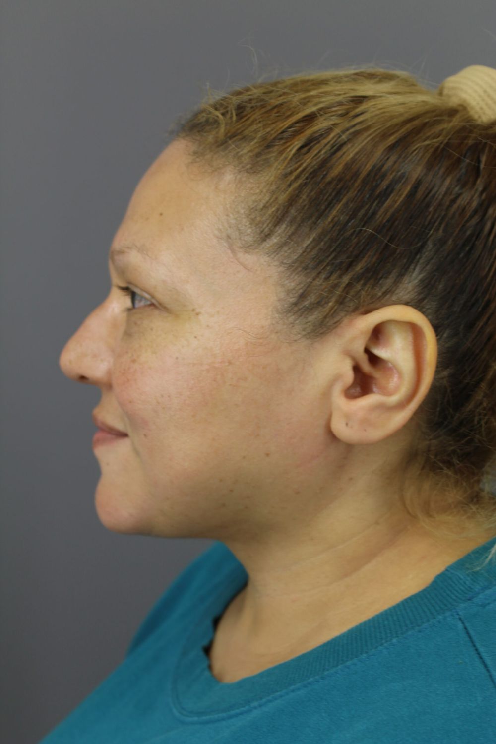 Neck Lift Before & After