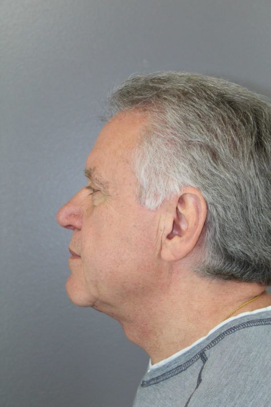 Neck Lift Before & After