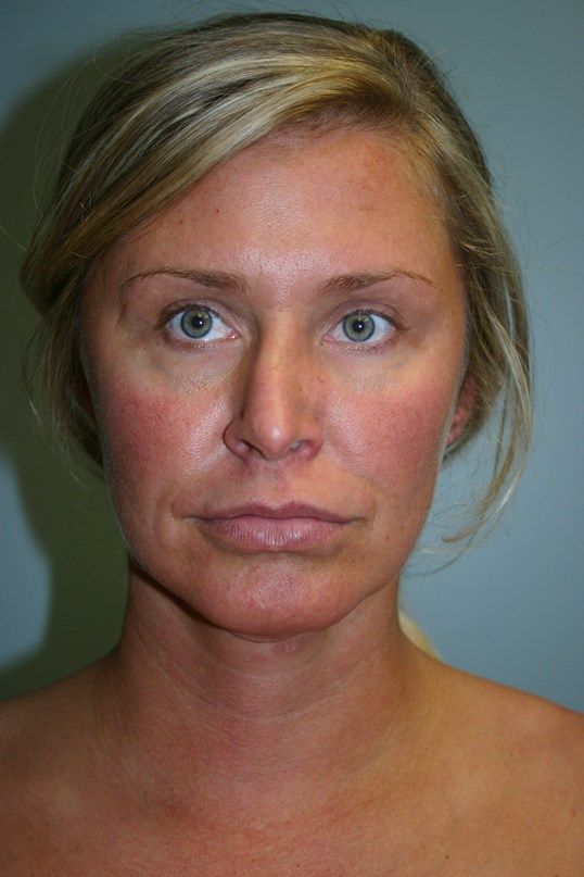 Neck Lift Before & After