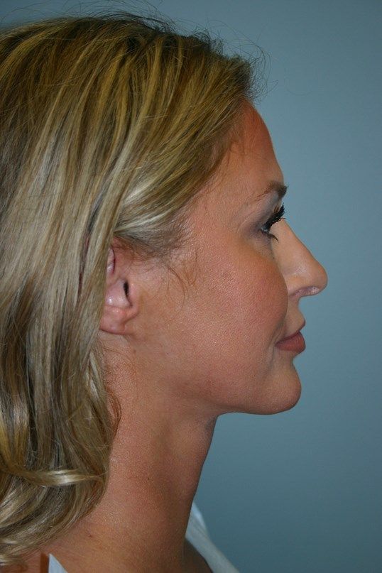 Neck Lift Before & After