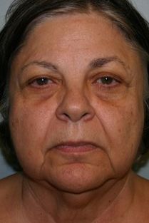 Neck Lift Before & After