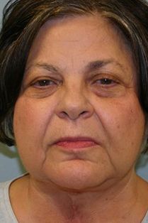 Neck Lift Before & After