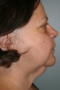 Neck Lift Before & After