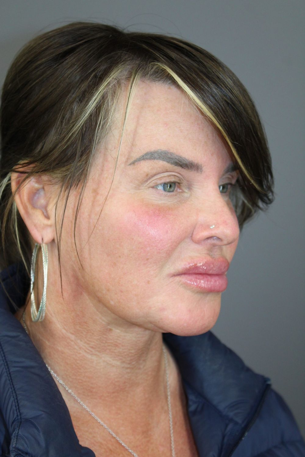 Neck Lift Before & After