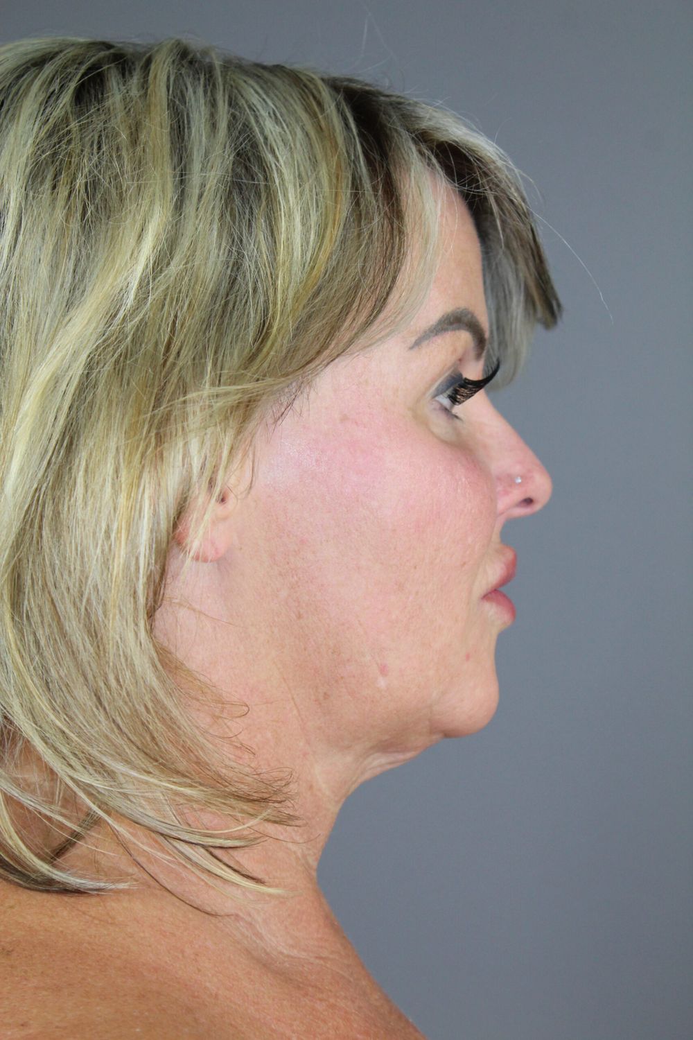 Neck Lift Before & After