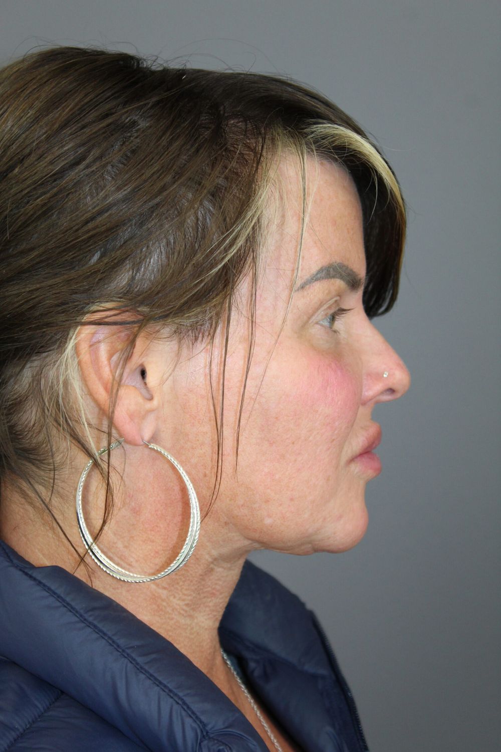 Neck Lift Before & After
