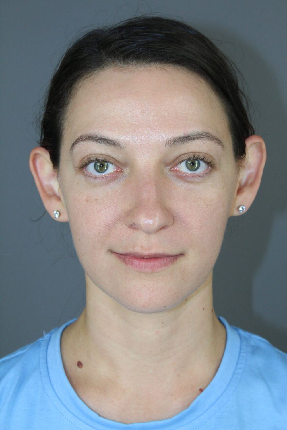 Ear Surgery Before & After