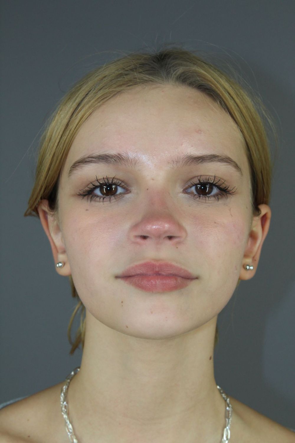 Ear Surgery Before & After