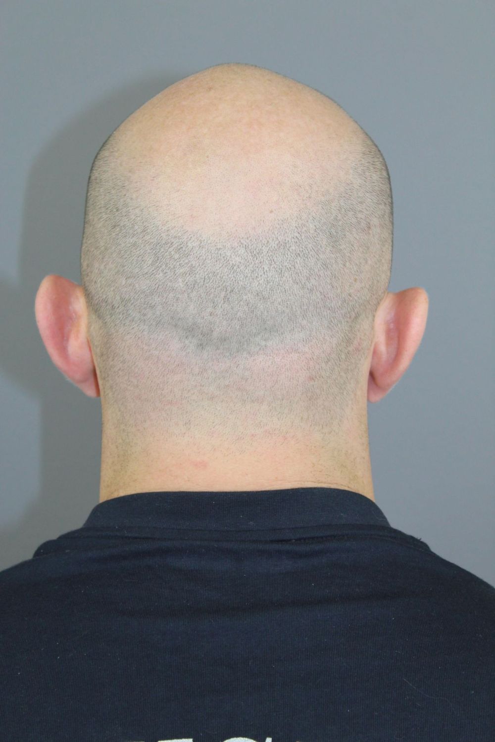 Ear Surgery Before & After