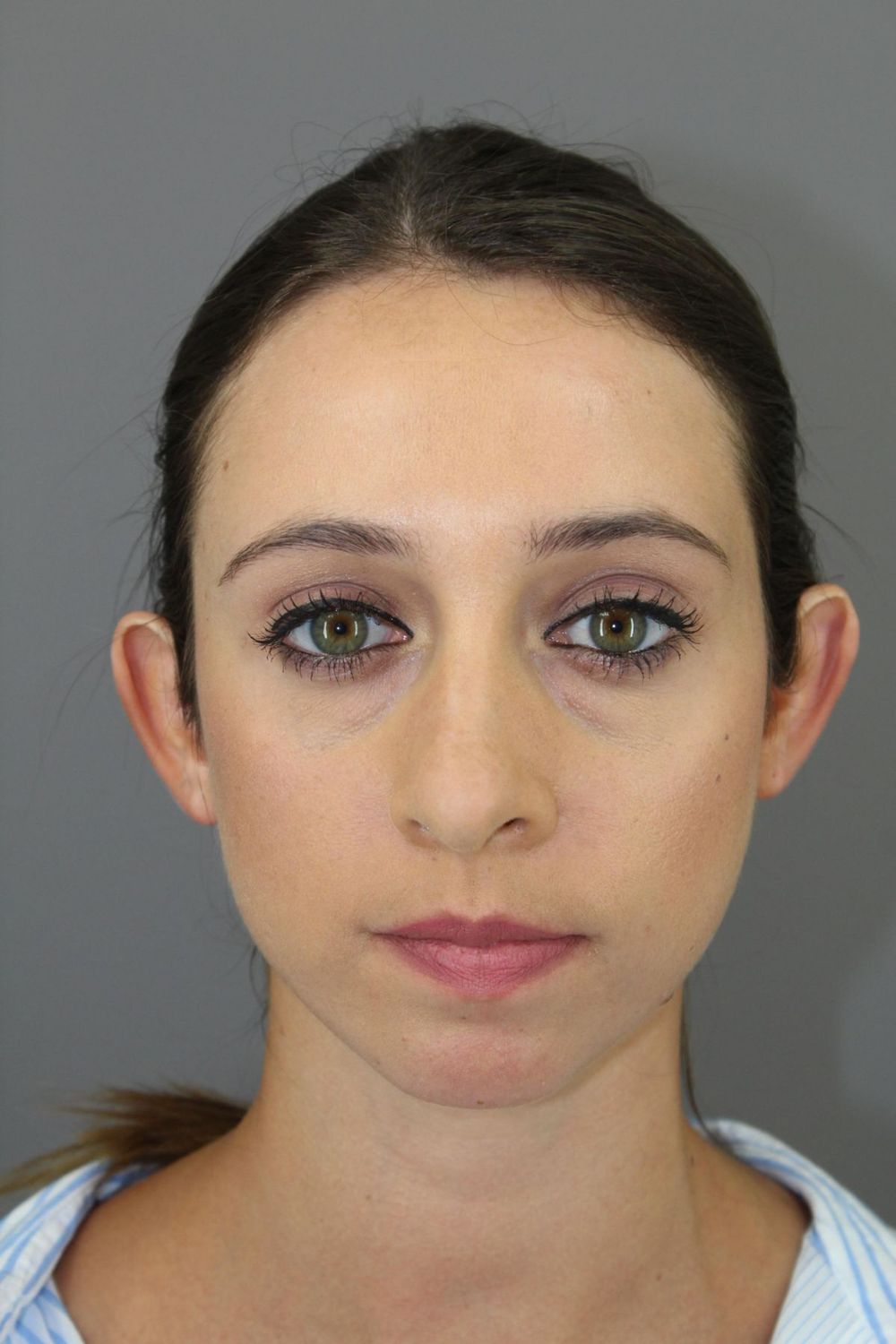 Ear Surgery Before & After