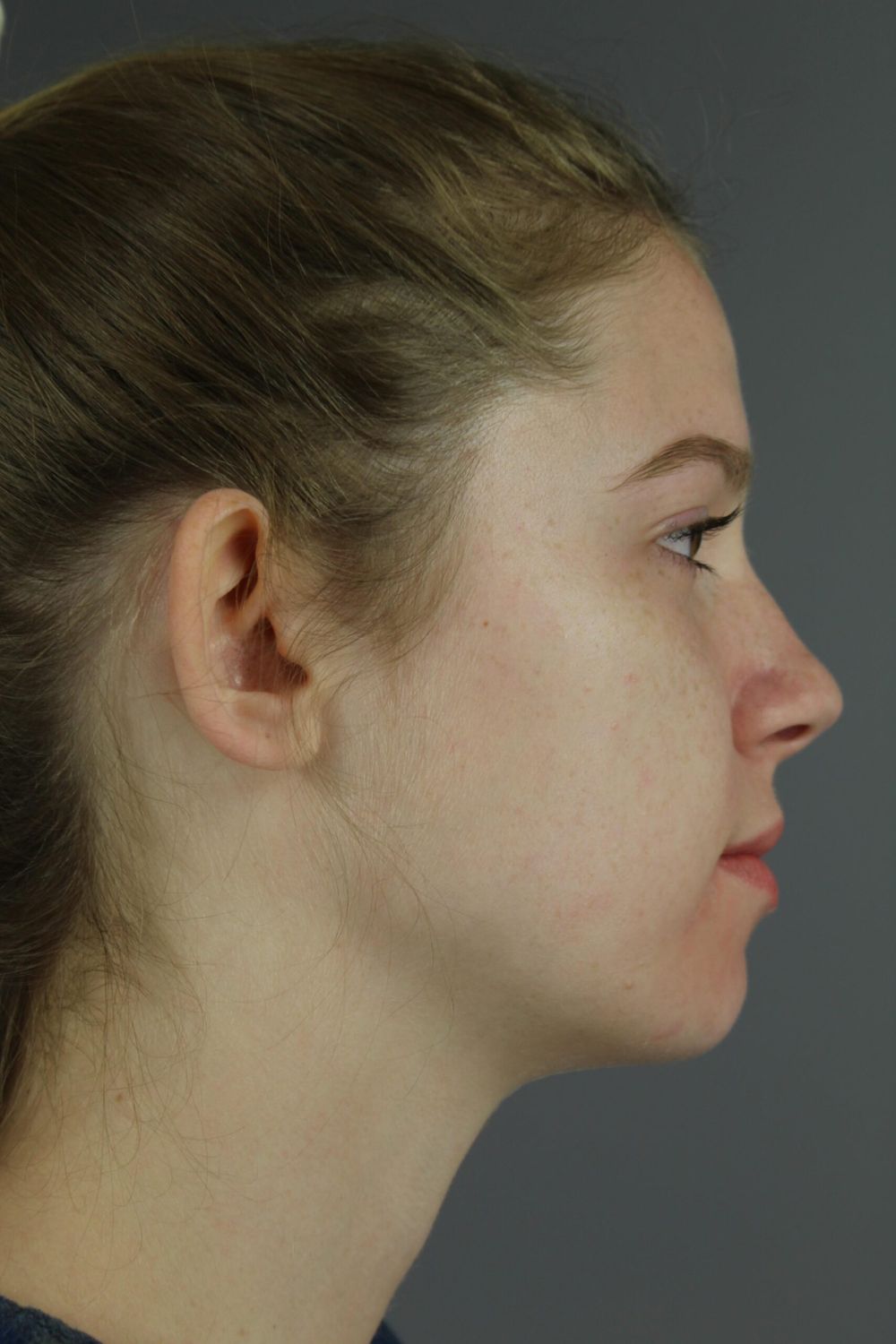 Ear Surgery Before & After