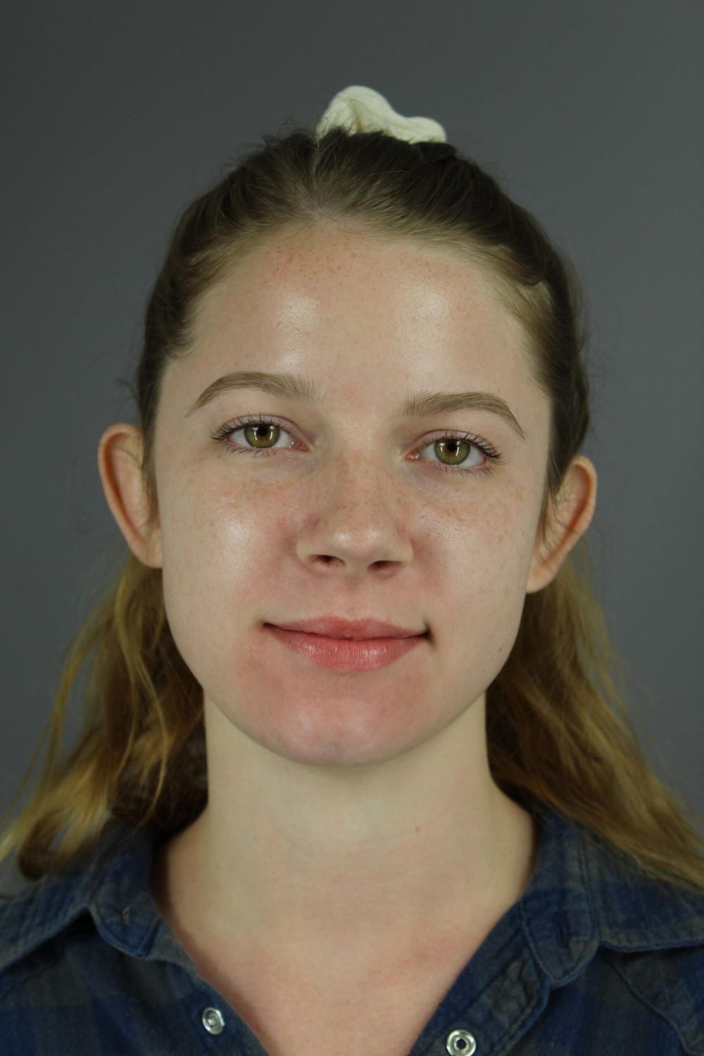 Ear Surgery Before & After