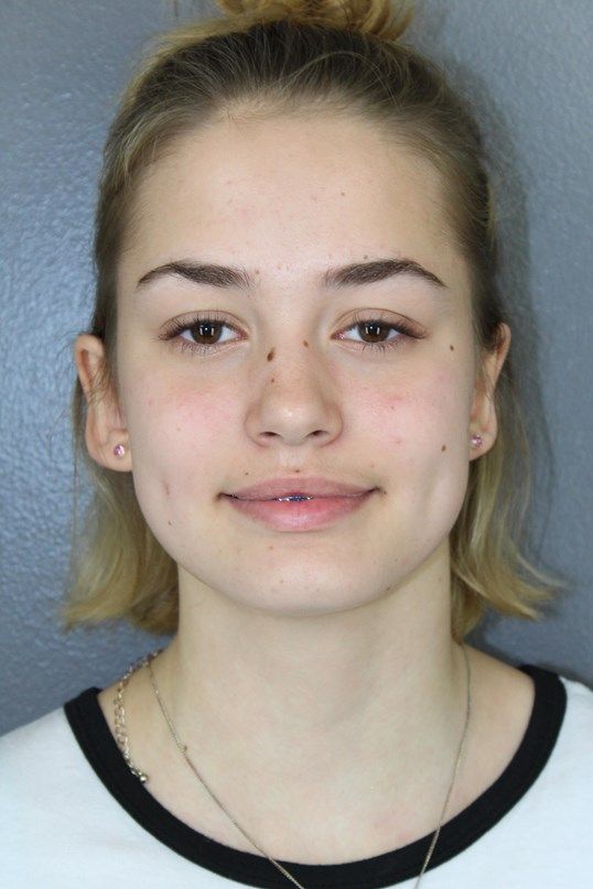 Ear Surgery Before & After