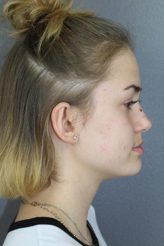 Ear Surgery Before & After