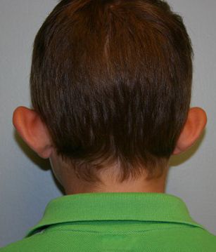 Ear Surgery Before & After