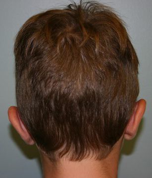 Ear Surgery Before & After