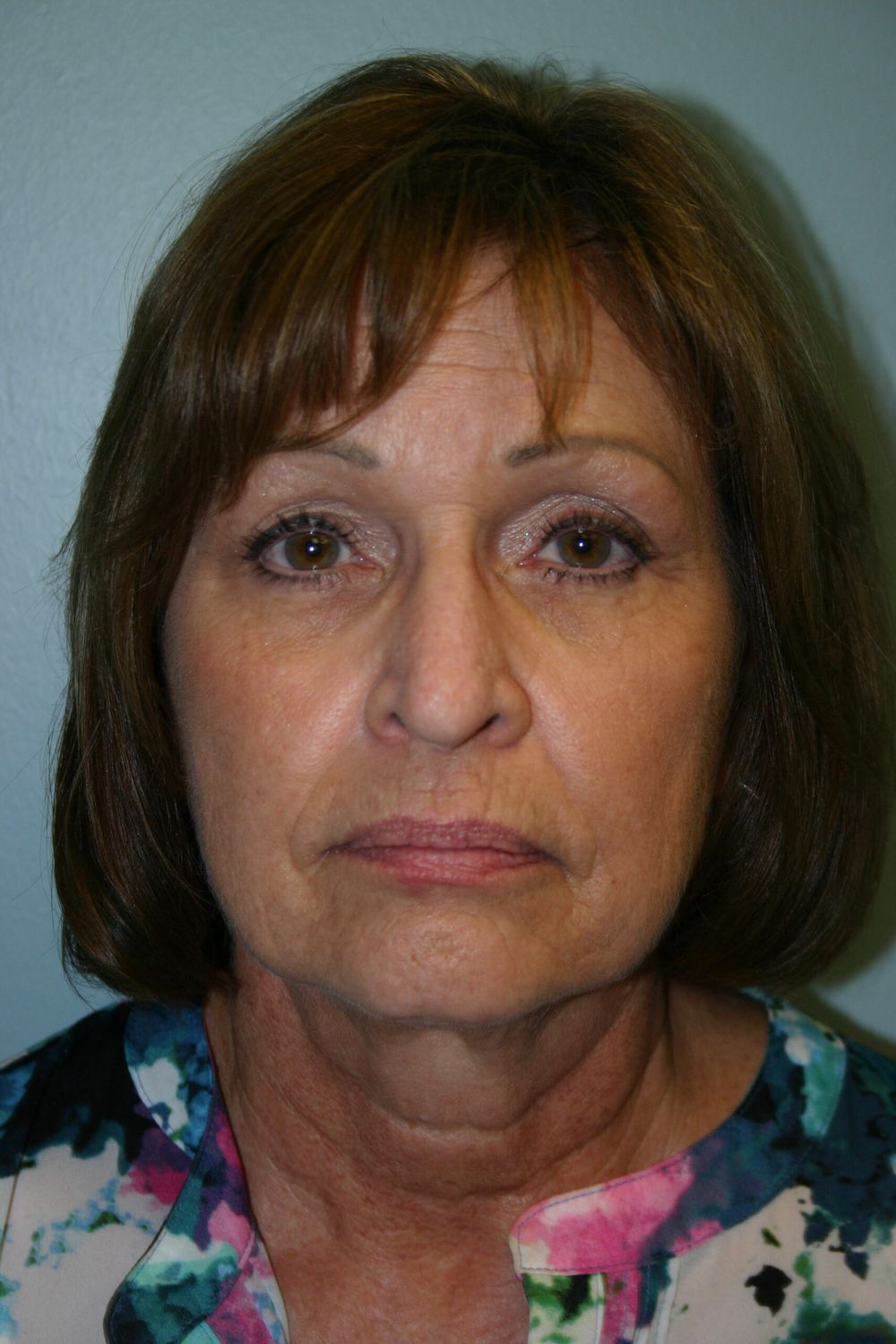 Croton Oil Peel Before & After