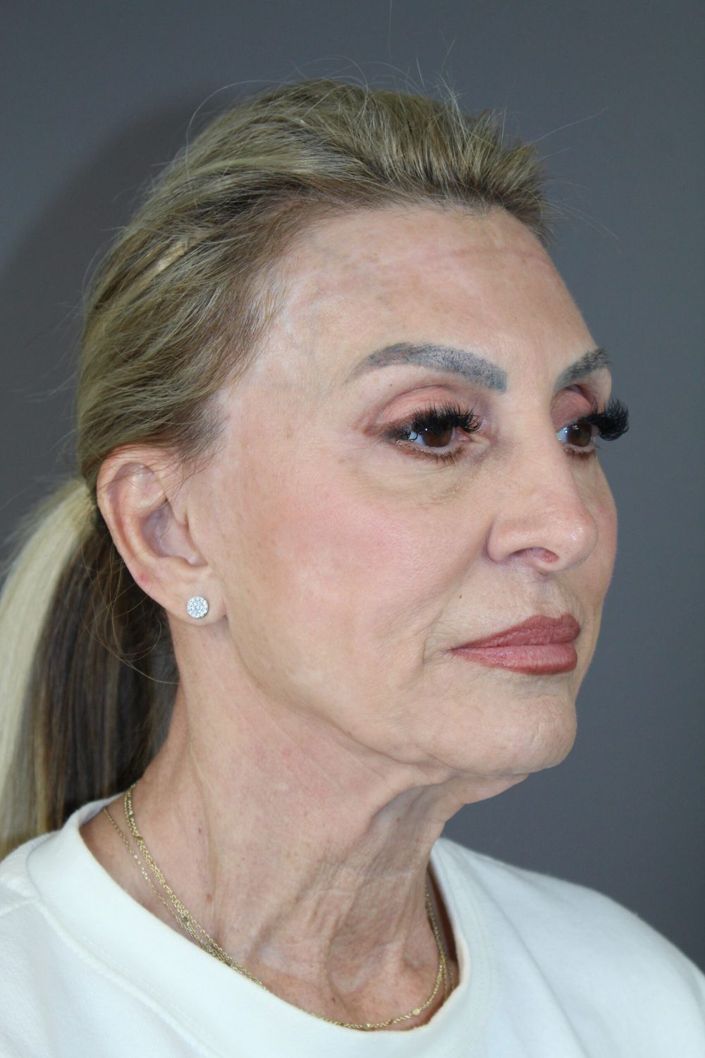 Croton Oil Peel Before & After