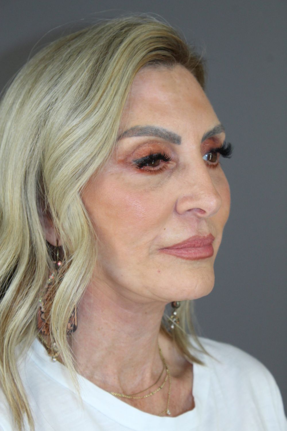 Croton Oil Peel Before & After