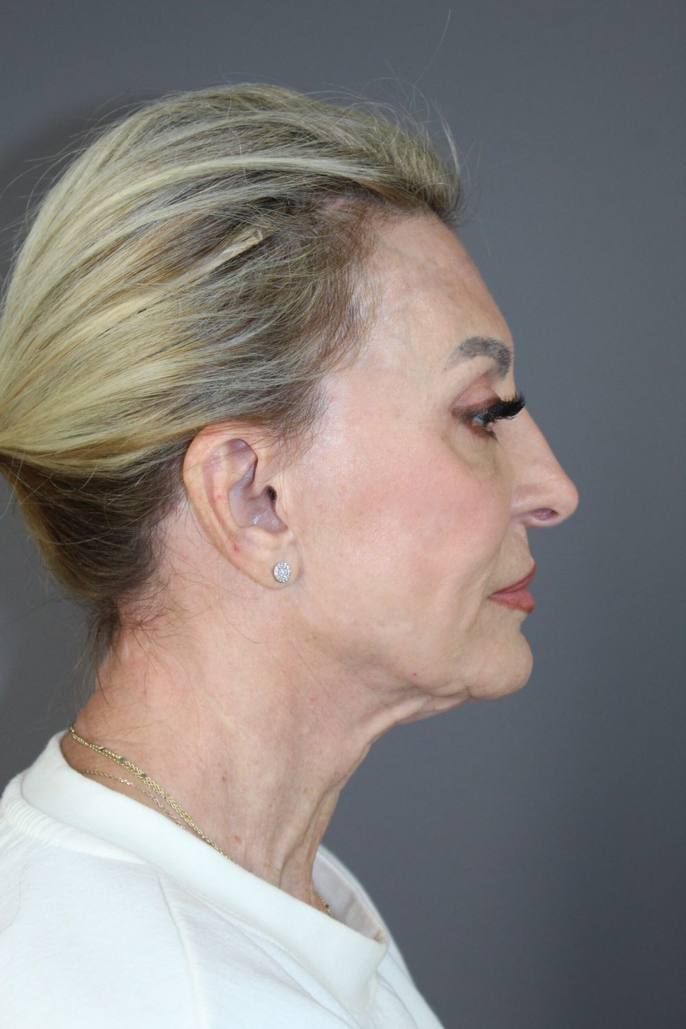 Croton Oil Peel Before & After