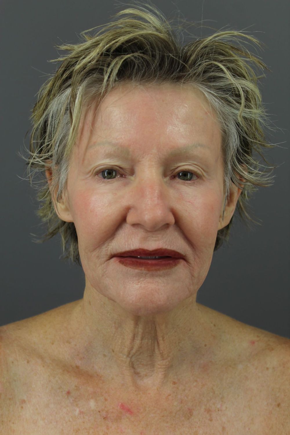 Croton Oil Peel Before & After