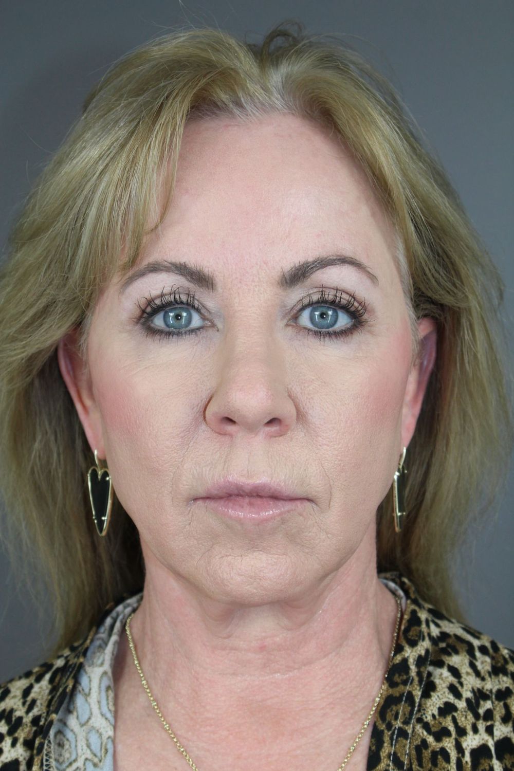 Croton Oil Peel Before & After