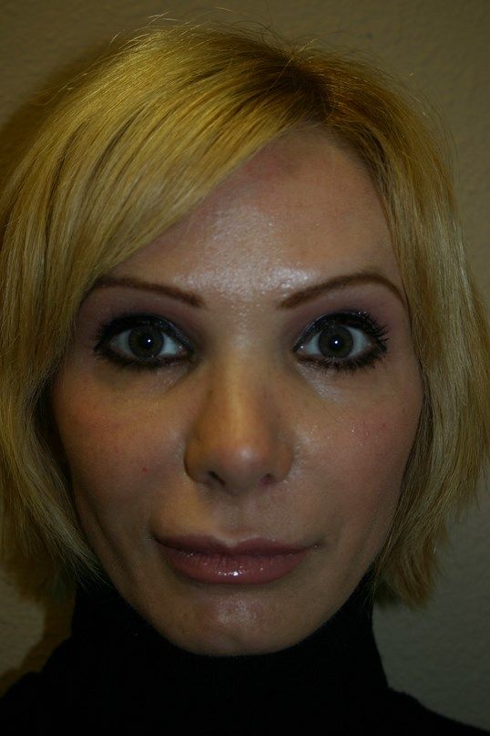 Croton Oil Peel Before & After