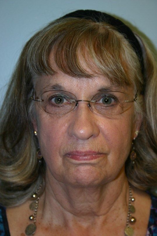 Croton Oil Peel Before & After