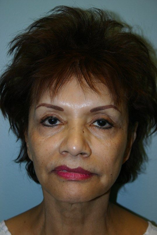 Croton Oil Peel Before & After