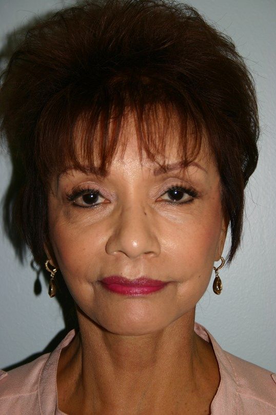 Croton Oil Peel Before & After