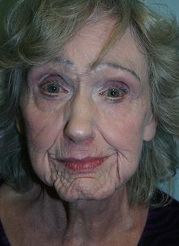 Croton Oil Peel Before & After