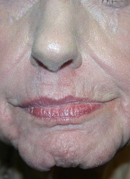 Croton Oil Peel Before & After