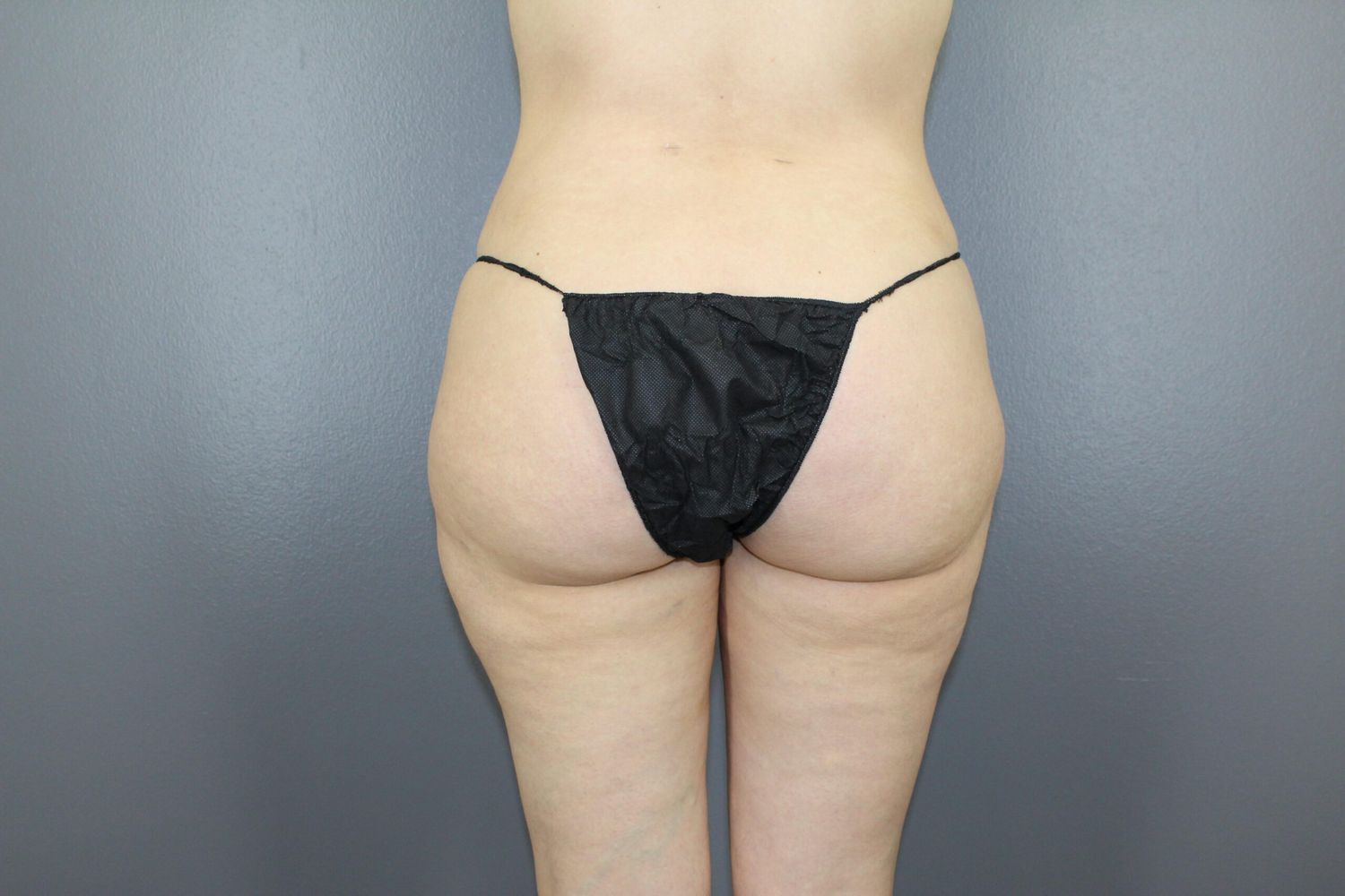 Brazilian Butt Lift Before & After