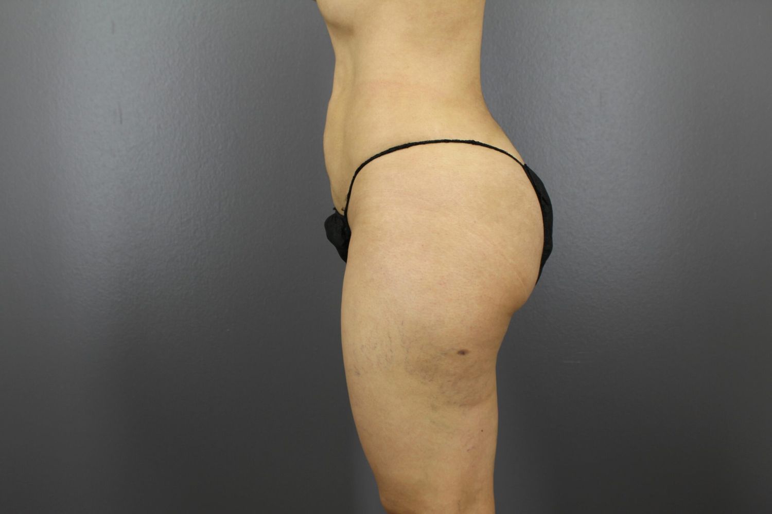 Brazilian Butt Lift Before & After