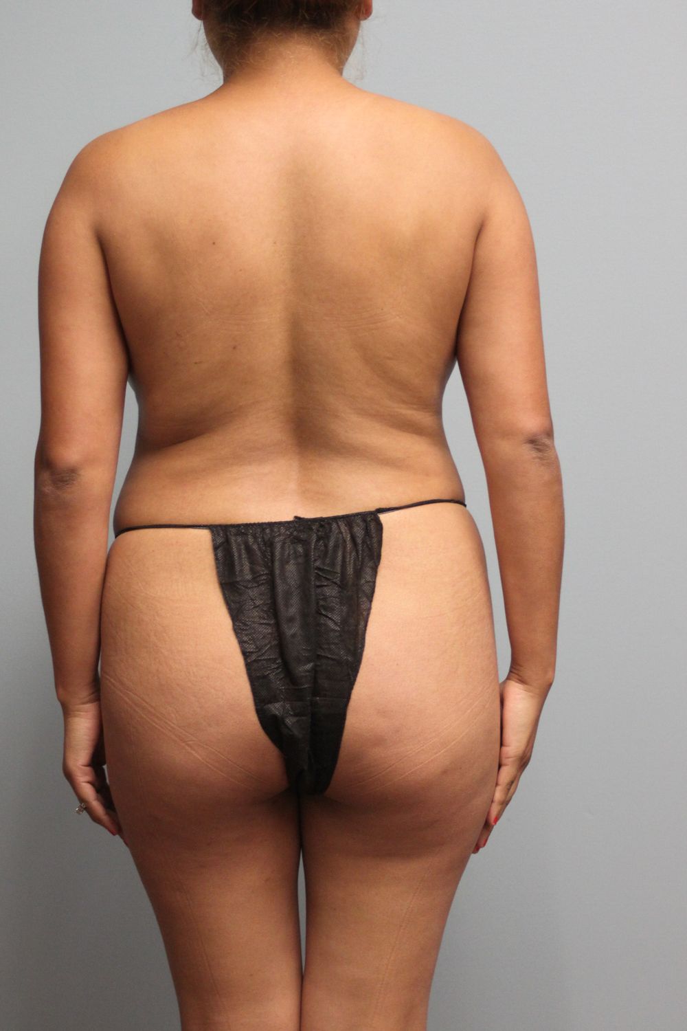 Brazilian Butt Lift Before & After