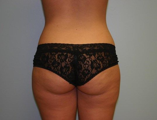 Brazilian Butt Lift Before & After