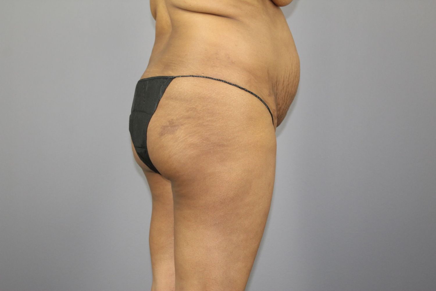 Brazilian Butt Lift Before & After