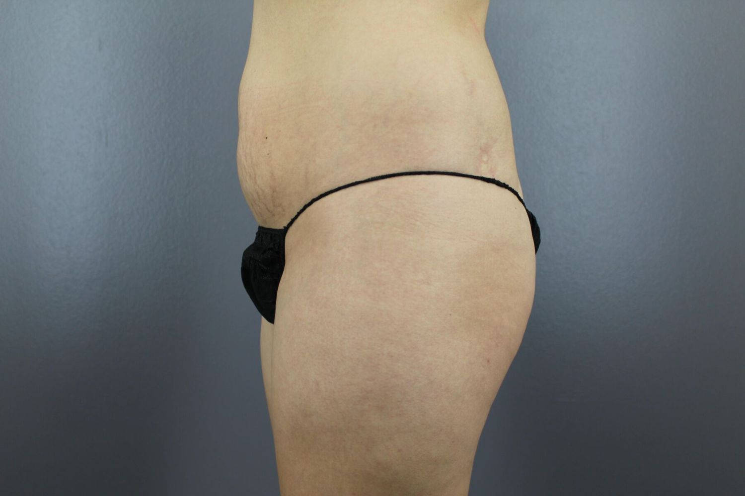 Brazilian Butt Lift Before & After